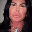 Gretchen faz nova harmonização facial e resultado surpreende; veja foto