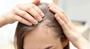 Alopecia: conheça tecnologias que devolvem força aos cabelos