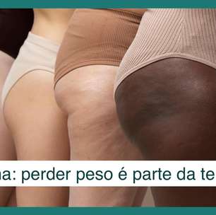 Lipedema: perda de peso é a terapia, mas não diminui inflamação das coxas