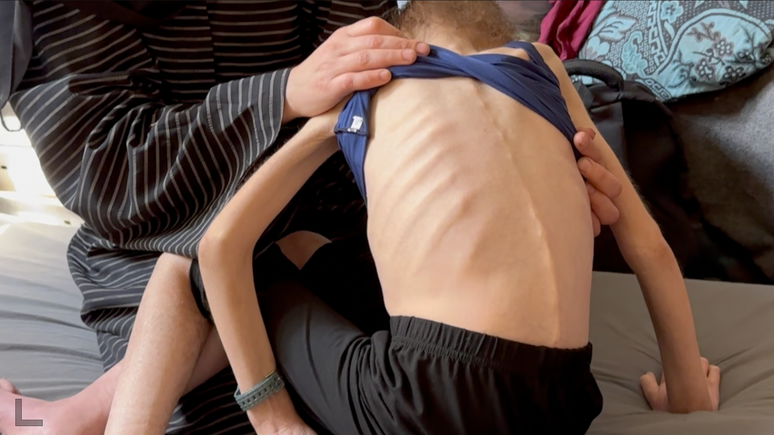 A ONU identificou 10 mil casos de desnutrição aguda entre crianças em Gaza desde janeiro
