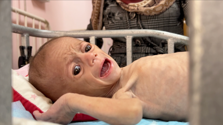 Um colega local da BBC registrou sinais inconfundíveis de desnutrição avançada no corpo da bebê Siwar